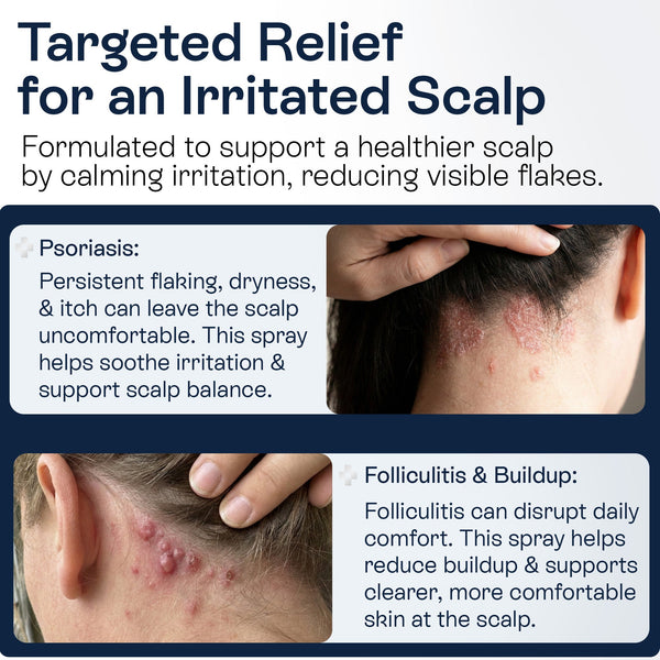 Psoriasis Scalp Spray for Flaking, Itching & Dryness
