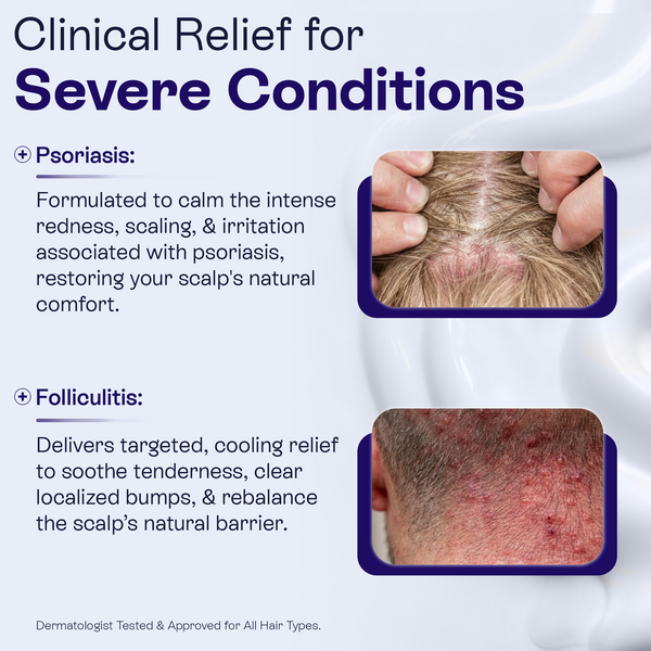 Keto Conditioner | Anti-Dandruff & Scalp Relief Care