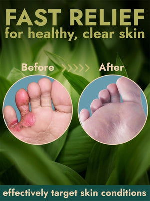 Antifungal Foot Gel