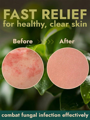 Antifungal Ringworm Spray