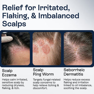 Psoriasis Scalp Spray for Flaking, Itching & Dryness