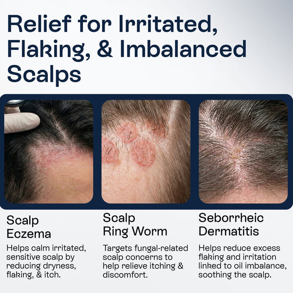 Psoriasis Scalp Spray for Flaking, Itching & Dryness