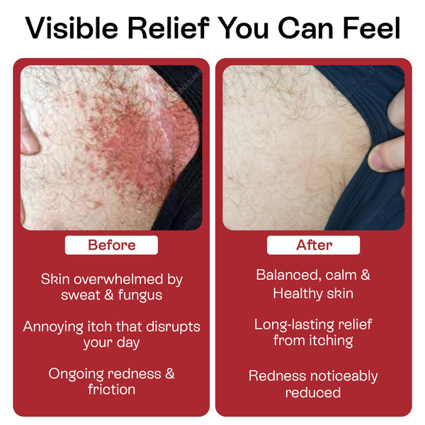 Jock Itch Antifungal Cream for Itching, Redness & Odor Relief