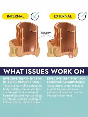 Hemorrhoid & Fissure Treatment 7 Applicators
