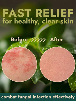 Antifungal Ringworm Cream