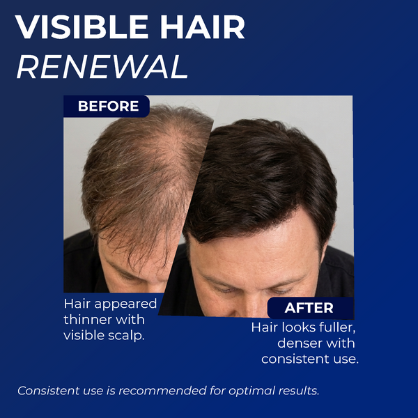 5% minoxidil for Men Spray
