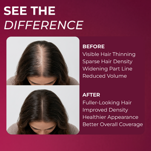 Minoxidil for Women Foams