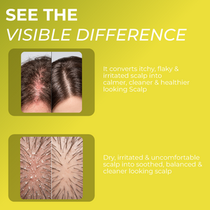 Folliculitis Scalp Spray