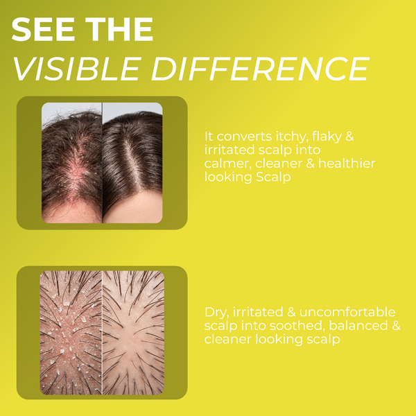 Folliculitis Scalp Spray