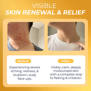 Psoriasis Big Lotion