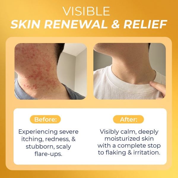 Psoriasis Big Lotion