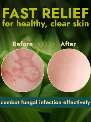 Antifungal Body Cream