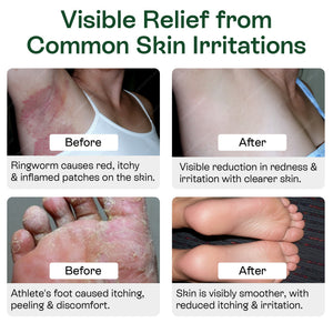 Medicated Antifungal Body Wipes for Ringworm, Jock Itch & Athlete’s Foot