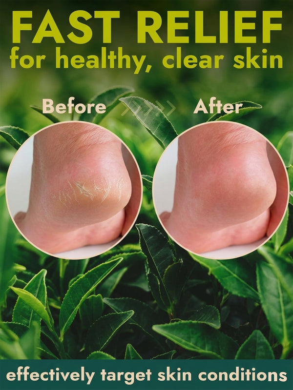 Callus Remover Gel