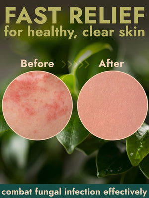 Tinea Spray
