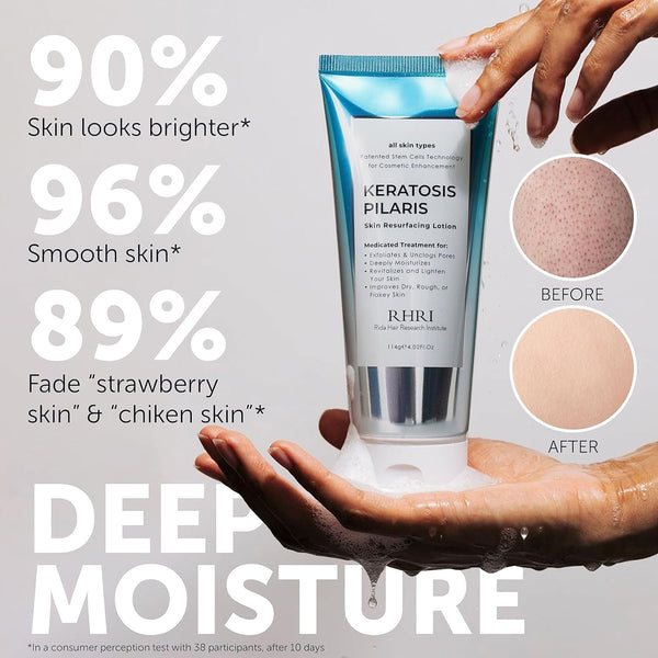 Keratosis Pilaris Treatment