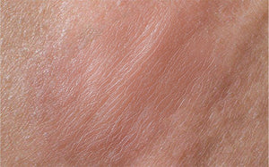 Terramed Just Think Comfort Herpes Genital Treatment