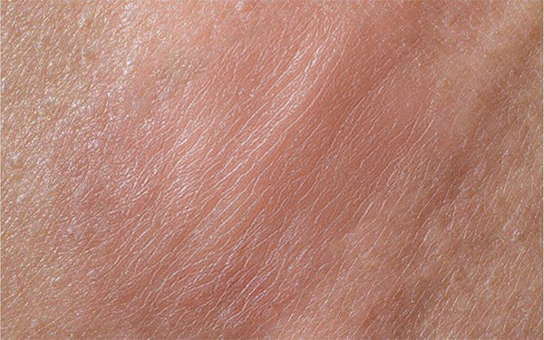 Terramed Just Think Comfort Herpes Genital Treatment