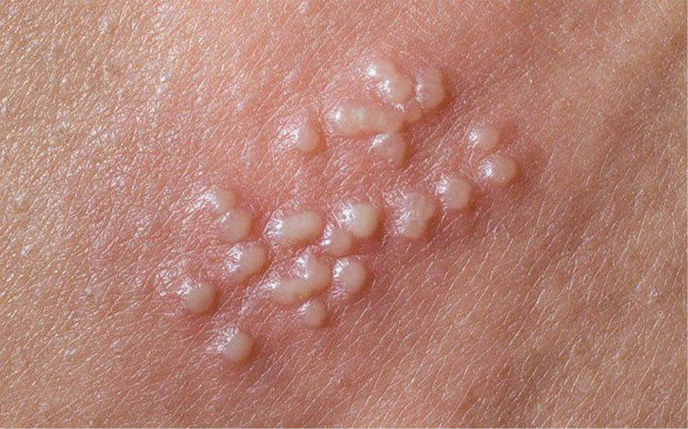 Terramed Just Think Comfort Herpes Genital Treatment