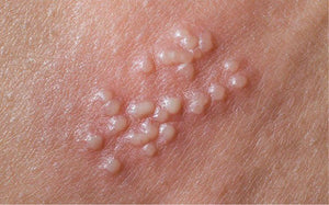 Terramed Just Think Comfort Herpes Genital Treatment