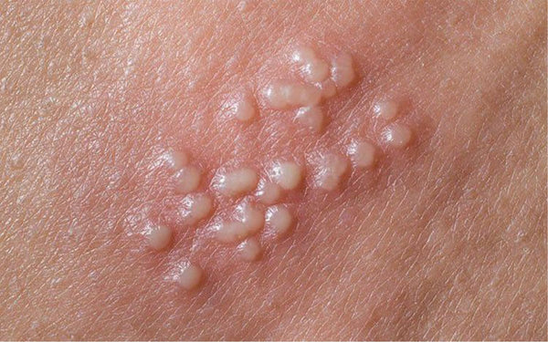 Terramed Just Think Comfort Herpes Genital Treatment