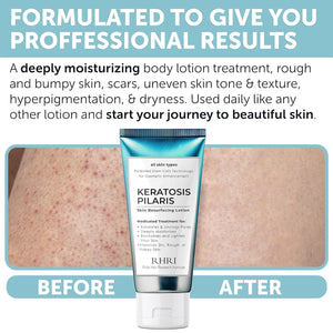 Keratosis Pilaris Treatment