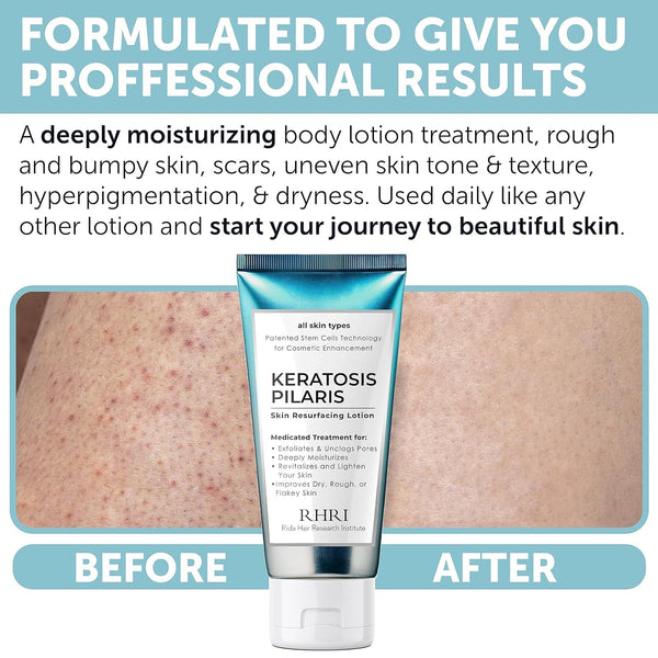 Keratosis Pilaris Treatment