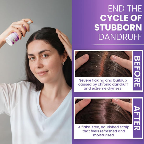 Neoketramin Anti Fungal Scalp Spray