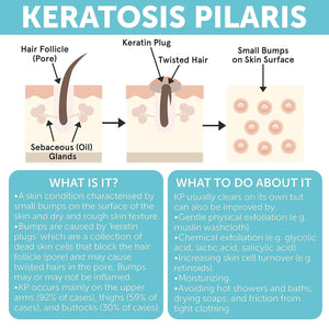 Keratosis Pilaris Treatment