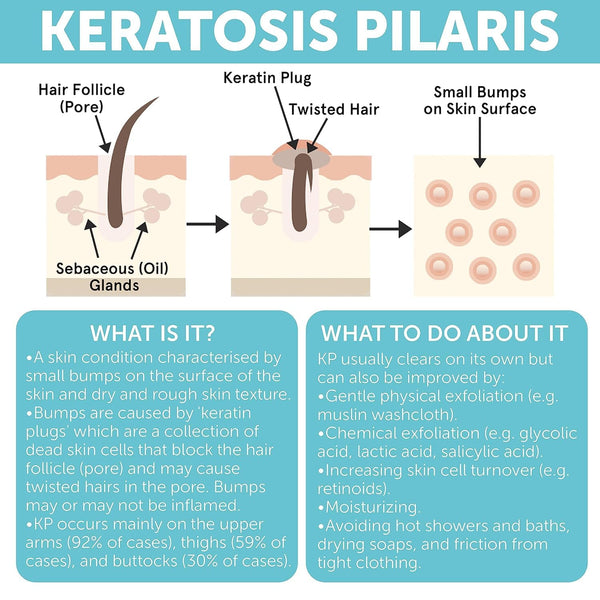 Keratosis Pilaris Treatment