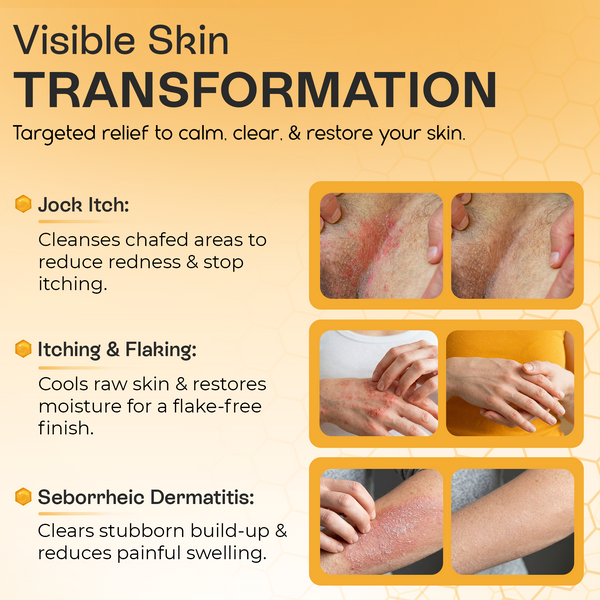 Psoriasis Body Wash | Itch, Redness & Flake Relief