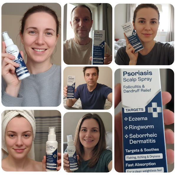 Psoriasis Scalp Spray for Flaking, Itching & Dryness