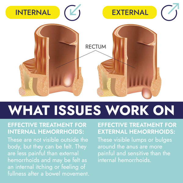 Hemorrhoid Treatment | Hemorrhoid & Fissure Ointment | 7 Pre-Filled Applicators | Fast & Effective | Hemorrhoids Treatment for Relief of Pain, Swelling, Discomfort & Itching