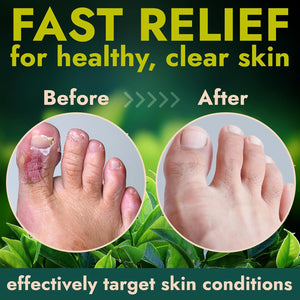 Antifungal Foot Powder with Miconazole Nitrate 2% & Tea Tree Oil