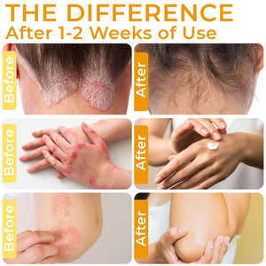 Psoriasis Cream