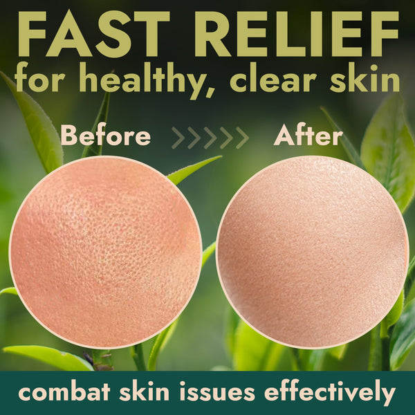 Clay Mask with Tea Tree Oil & Volcanic Ash - Face & Body Mask for Redness Relief, Itchy Skin, Excess Sebum, and Dryness - Daily Use for Clear, Smooth Skin - Tea Tree Skincare Treatment