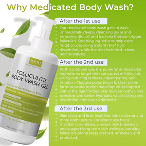 Folliculitis Body Wash