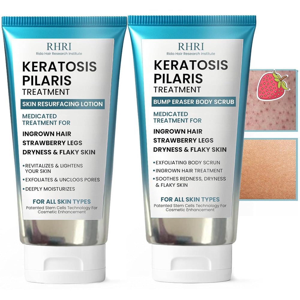 Keratosis Pilaris Treatment