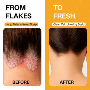 Pharmlitalia Psoriasis Shampoo for Dry & Itchy Scalp with Salicylic Acid 3% - Psoriasis Scalp Treatment for Eczema Relief, Seborrheic Dermatitis, Ringworm & Folliculitis