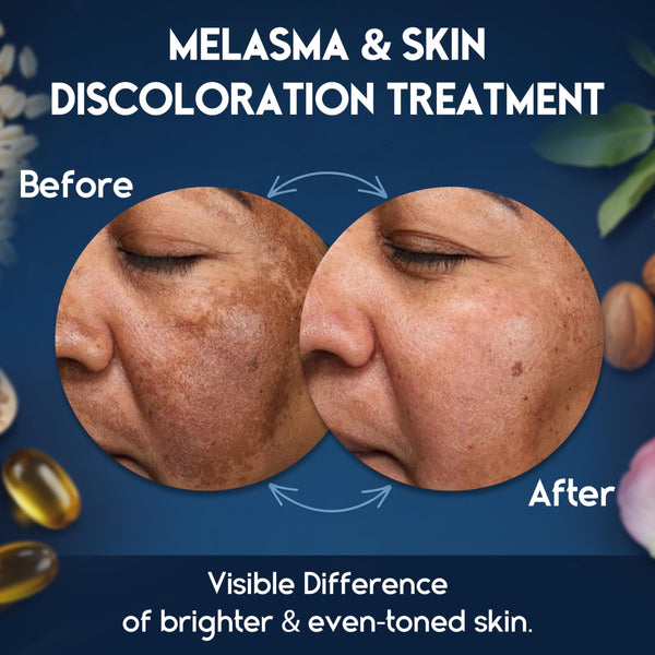 Melasma and Initmate Cream