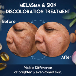 Melasma and Initmate Cream