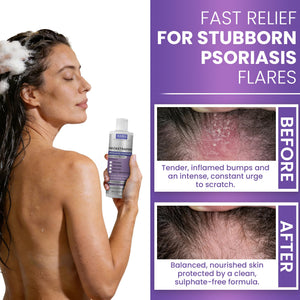Anti Fungal Shampoo for Men & Women | Anti Dandruff, Medicated, Folliculitis Shampoo for Dry Scalp, Psoriasis, Ringworm | for Itchy, Flaky & Irritated Scalp | No Paraben & Sulphate | w/Scrubber Brush