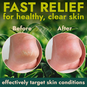 Callus Remover for Feet