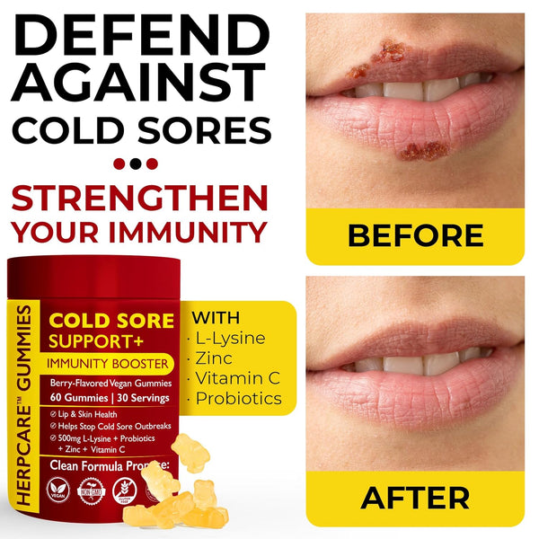 Cold Sore Treatment for Lip & Skin