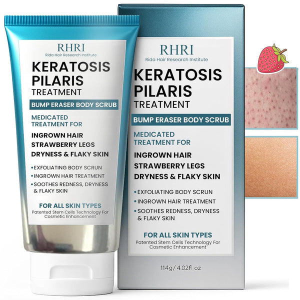 Keratosis Pilaris Treatment