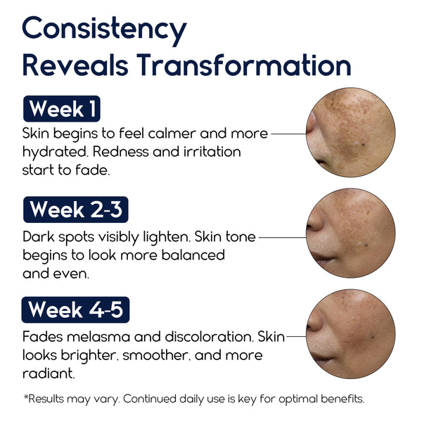 Melasma and Initmate Cream