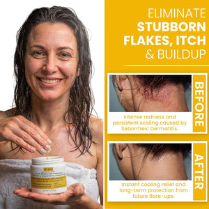 Scalp Scrub for Psoriasis