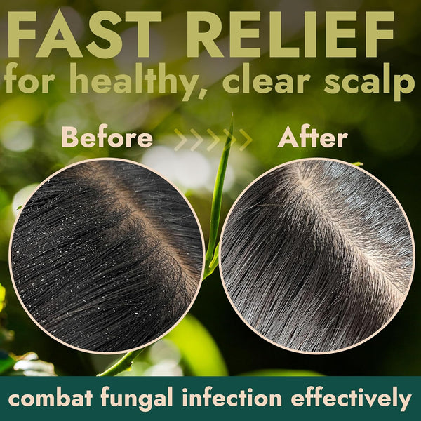 Tea Tree Scalp Scrub for Itchy & Dry Scalp