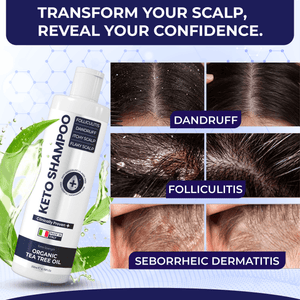 Keto Shampoo for Dandruff, Psoriasis, Folliculitis & Seborrheic Dermatitis | Anti-Fungal Itchy Scalp Relief