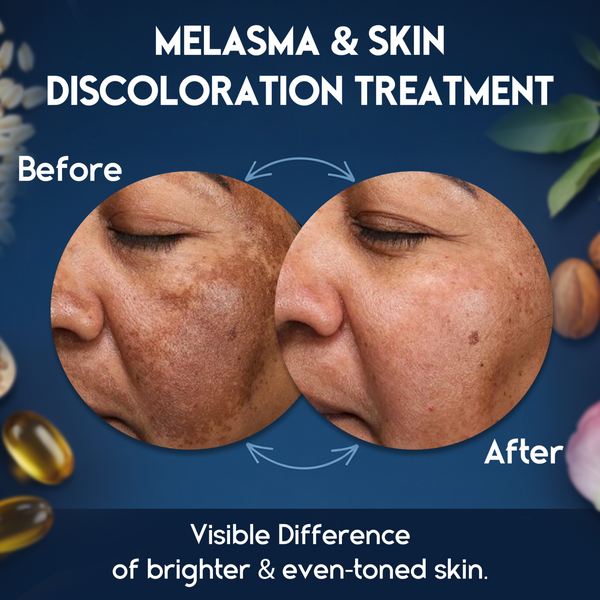 Melasma Cream & Dark Spot Remover for Skin Discoloration, Post-Blemish Marks, Scars & Spots